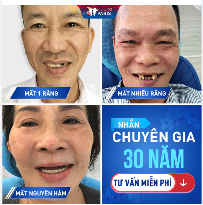 Đảm bảo ăn nhai, thẩm mỹ tuyệt đối, bền chắc 40 năm