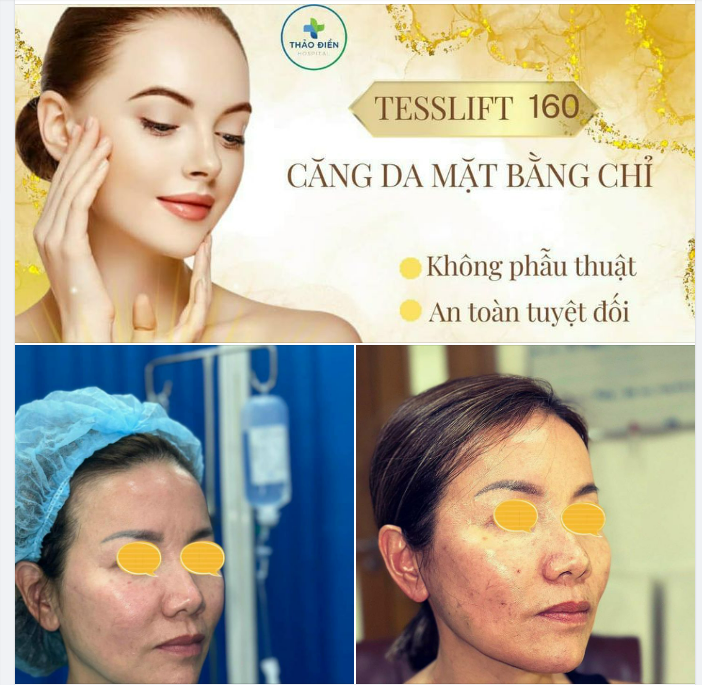 CĂNG DA MẶT BẰNG CHỈ TESSLIFT 160- LẤY LẠI NÉT XUÂN RẠNG NGỜI