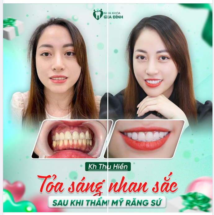 HOÀN THIỆN NHAN SẮC, TỎA SÁNG VỚI NỤ CƯỜI XINH ĐẸP SAU KHI THẨM MỸ RĂNG SỨ