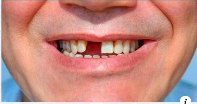 Không trồng răng giả sau khi nhổ răng có sao không?