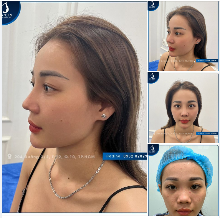 Dáng mũi bán cấu trúc 1 năm siêu xinh nhà Latin