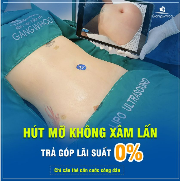 LIPO ULTRASOUND - CÔNG NGHỆ HÚT MỠ KHÔNG XÂM LẤN ĐỘC QUYỀN GANGWHOO