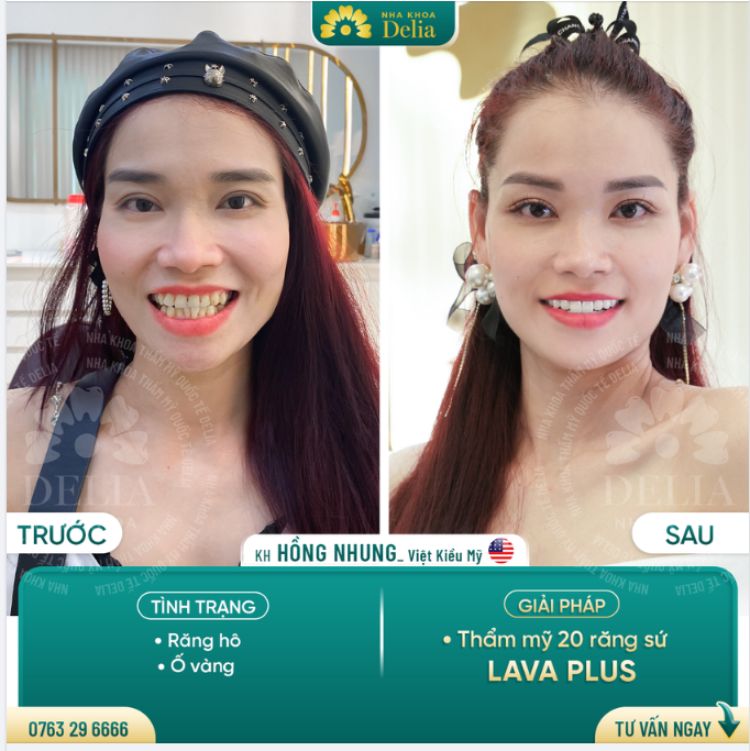 Răng khấp khểnh không dám cười - Chỉ sau 2 lần hẹn Việt Kiều Mỹ tự tin cười rạng rỡ