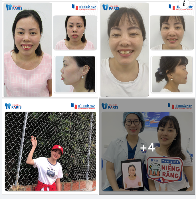 Niềng Răng Case Khó