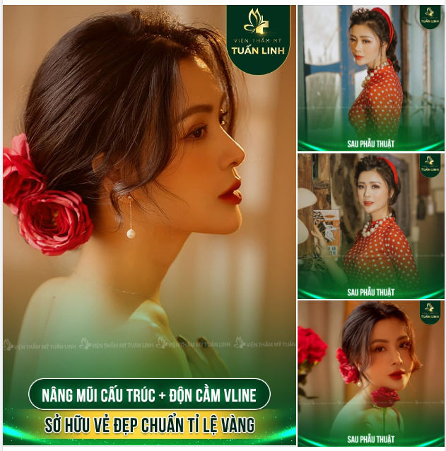 Nâng mũi cấu trúc + Độn cằm Vline = Luôn là lựa chọn hàng đầu nếu muốn sở hữu gương mặt chuẩn tỉ lệ vàng.