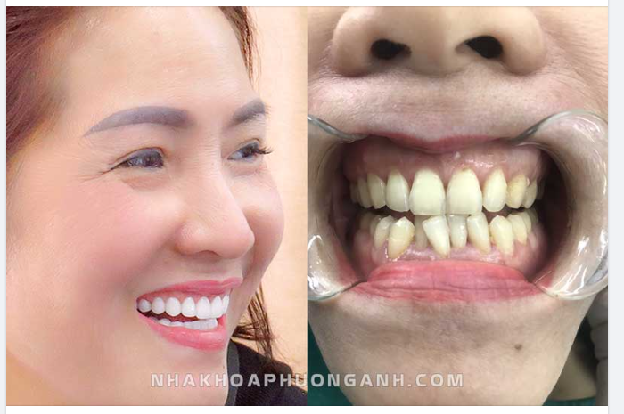 Dáng răng và khuôn mặt có liên quan với nhau