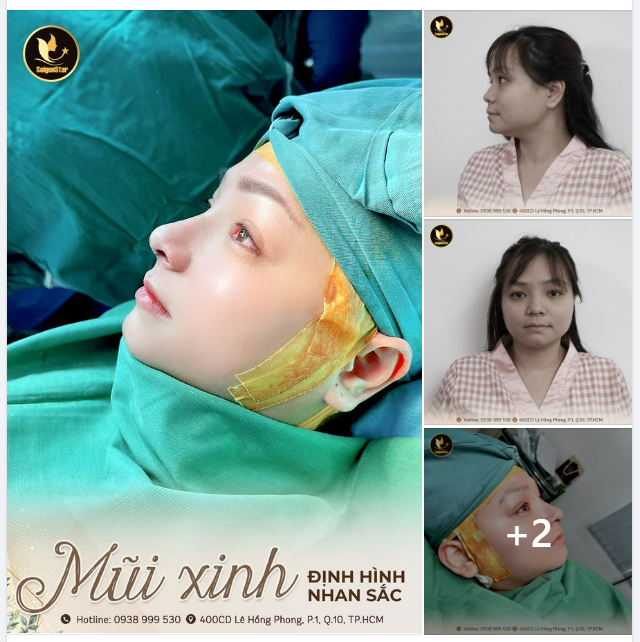 MŨI XINH ĐỊNH HÌNH NHAN SẮC
