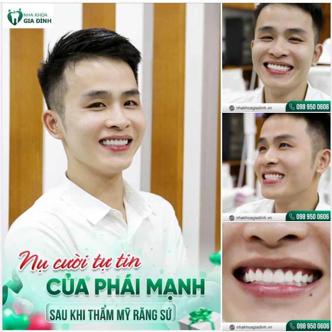 Khi người đàn ông thẩm mỹ răng sứ sẽ thế nào?