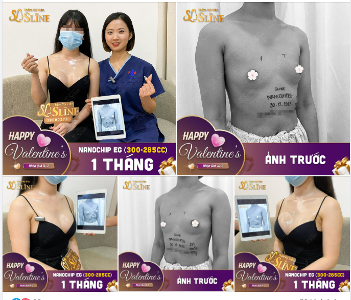 NGẮM NHÌN kết quả sau nâng ngực 1 tháng với dòng túi Nanochip Ergonomix.