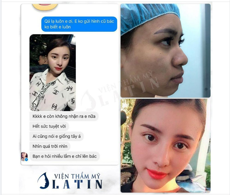 Feedback siêu yêu nhà Latin với Combo: Bấm mí 4D + Độn cằm + Nâng mũi cấu trúc.