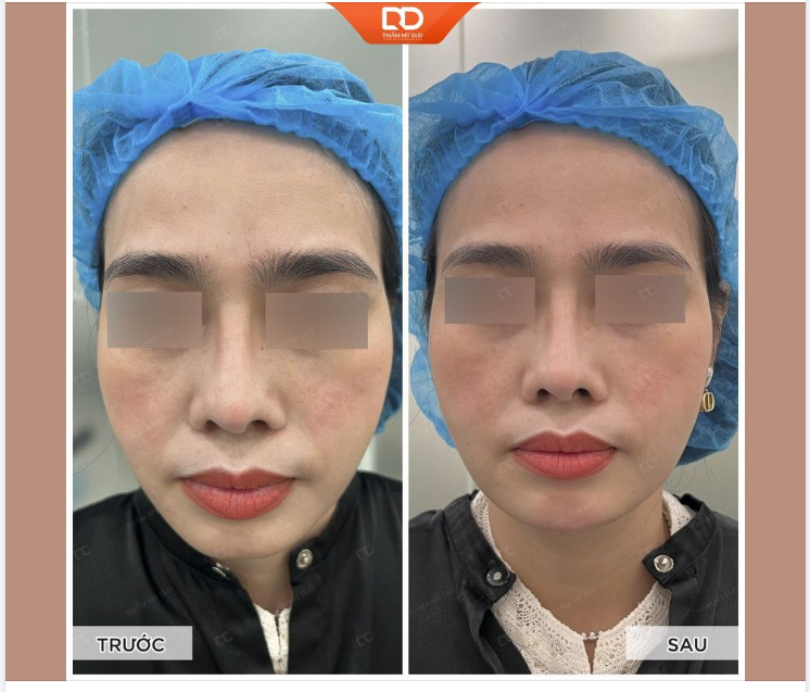 Tiêm Filler cằm - Tạo hình nhanh chóng, an toàn, không cần nghỉ dưỡng!
