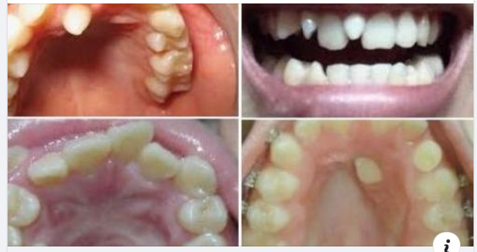 Có Răng Mọc Thừa Giữa 2 Răng Cửa Thì Phải Làm Sao?