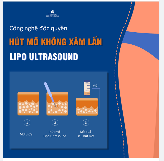 CÔNG NGHỆ ĐỘC QUYỀN HÚT MỠ KHÔNG XÂM LẦN - LIPO ULTRASOUND