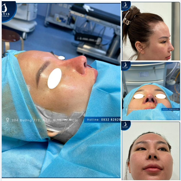 Mũi cấu trúc sụn sườn sửa lại đẹp xuất sắc
