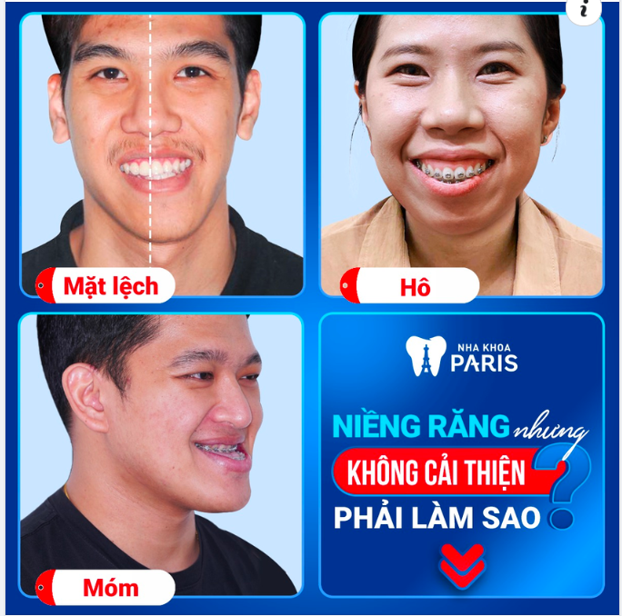 Phẫu thuật hàm mặt - Giải quyết triệt để các tình trạng HÔ - MÓM - MẶT LỆCH do xương
