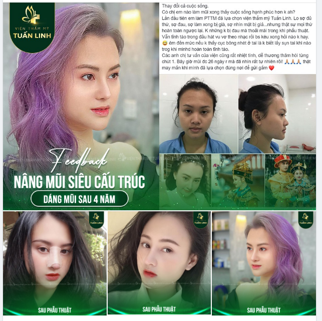 Feedback Nâng mũi siêu cấu trúc - Dáng mũi sau 4 năm nâng tại Tuấn Linh - Đẹp xuất sắc!!