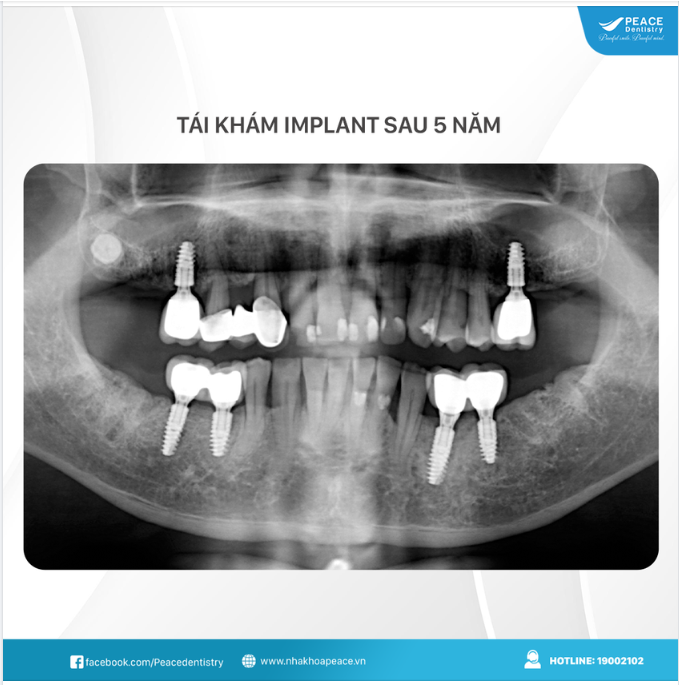TÁI KHÁM IMPLANT SAU 5 NĂM - CHIA SẺ TỪ KHÁCH HÀNG: "CẢM GIÁC ĂN NHAI Y NHƯ RĂNG THẬT".