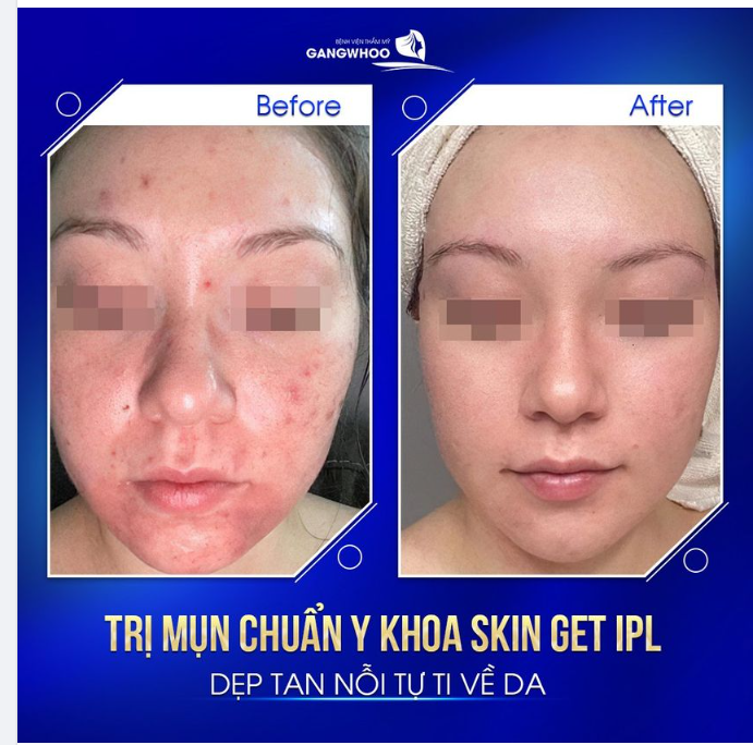 BÍ QUYẾT ĐỂ DA HẾT MỤN HOÀN TOÀN CÙNG CÔNG NGHỆ ĐIỀU TRỊ MỤN SKIN GET IPL