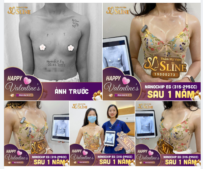 Feedback nâng ngực  sau 1 năm