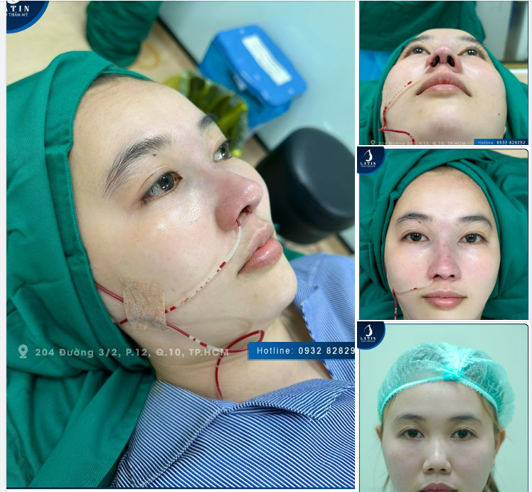 Dáng mũi xinh ngay sau khi vừa được sửa lại