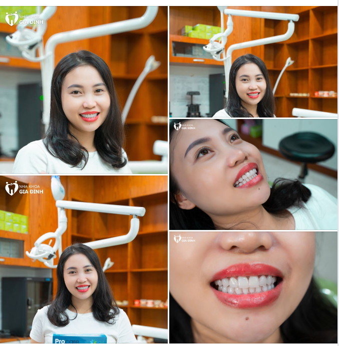 NỤ CƯỜI TỎA SÁNG CỦA KHÁCH HÀNG NGUYỄN GIANG SAU KHI DÁN SỨ VENEER TẠI NHA KHOA GIA ĐÌNH