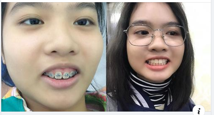Cần đeo hàm duy trì bao lâu sau khi tháo niềng răng ?