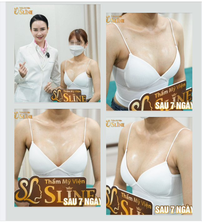 NGỰC ĐẸP  SAU 7 NGÀY.