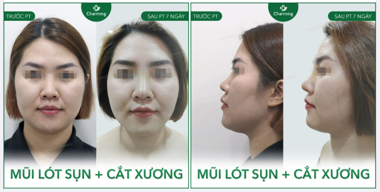 Dạo này không hiểu năng lượng gì mà ảnh của khách nâng mũi đa số đều đi kèm với phẫu thuật cắt xương dzị ta? 