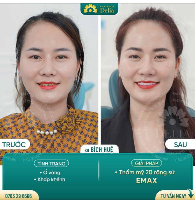 KHẮC PHỤC TRIỆT ĐỂ RĂNG Ố VÀNG, KHẤP KHỂNH SAU 2 LẦN HẸN