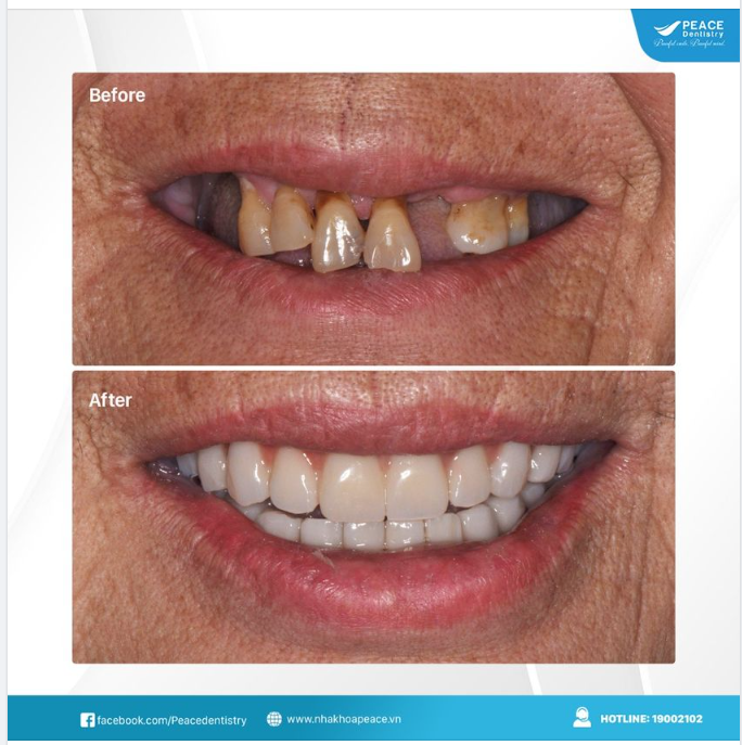 Ca lâm sàng  Trồng răng Implant All-on-4 cho khách hàng lớn tuổi