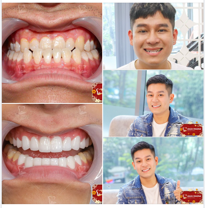 NIỀNG RĂNG ĐỂ LÀM SỨ THÌ MẤT THỜI GIAN BAO LÂU?