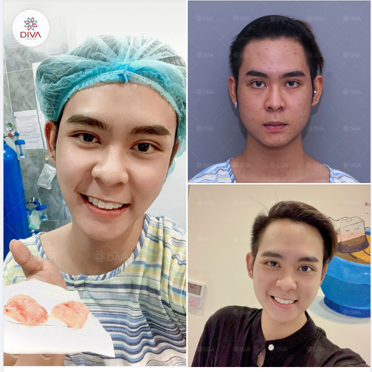 ĐẦU NĂM LẤY TÚI MỠ MÁ - CẢ NĂM MẶT GỌN, THANH THOÁT