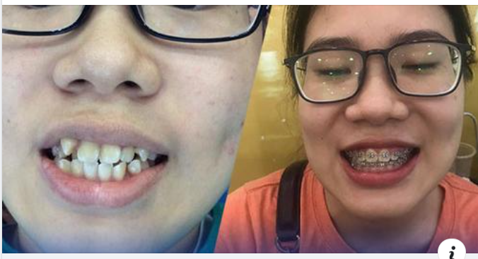 Lưu ý khi niềng răng, chỉnh nha
