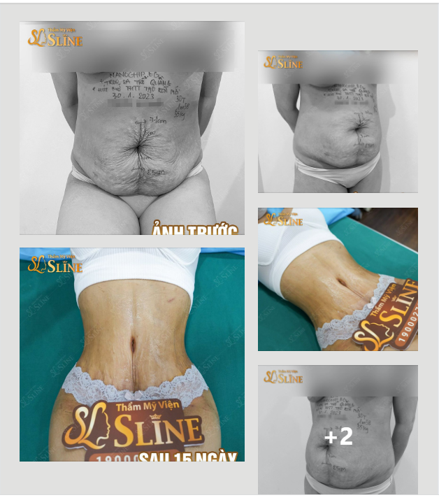 VÒNG 2 XẬP XỆ SAU SINH.
