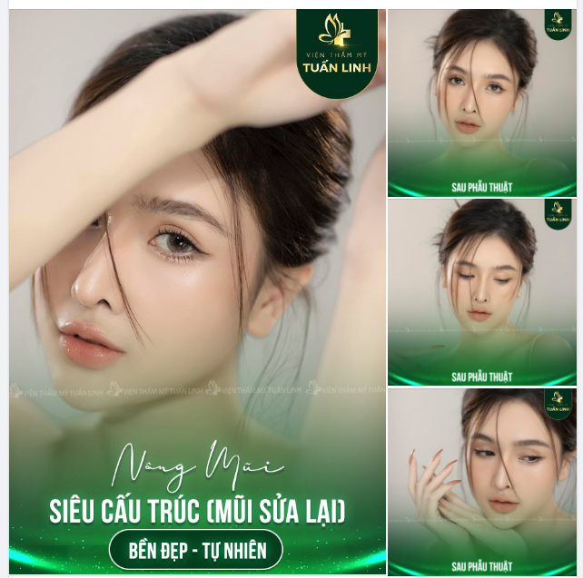 Nâng mũi siêu cấu trúc ( mũi sửa lại ) - Cho dáng mũi Bền đẹp - Tự nhiên