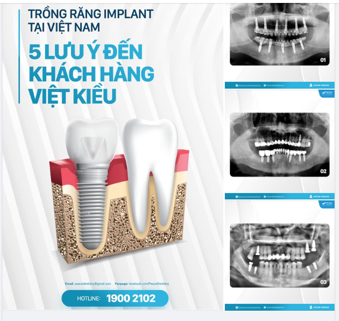 TRỒNG RĂNG IMPLANT TẠI VIỆT NAM