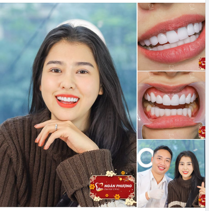 5 năm một nụ cười xinh  Răng sứ sáng đẹp, lung linh dịu dàng