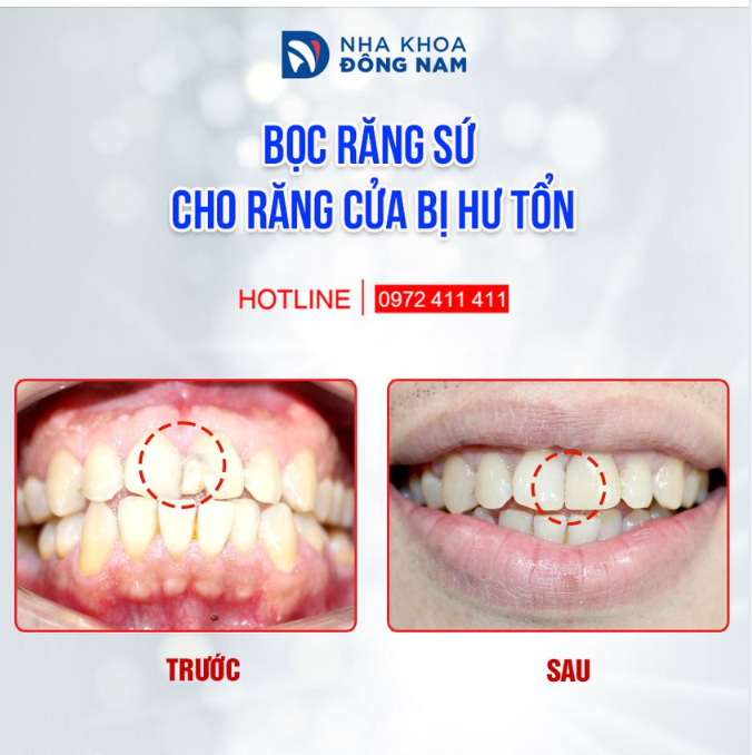 Nhiều người bọc sứ răng cửa bị hô, nhô ra phía trước nhiều, đó là vì tỉ lệ cân chỉnh chưa phù hợp và kĩ thuật chế tác mão sứ thô và dày.