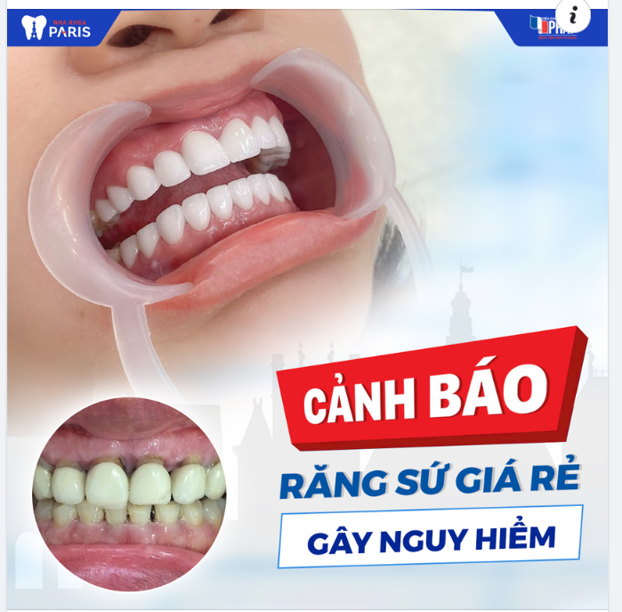 Răng sứ giá rẻ nhưng hậu quả cực kỳ đắt!