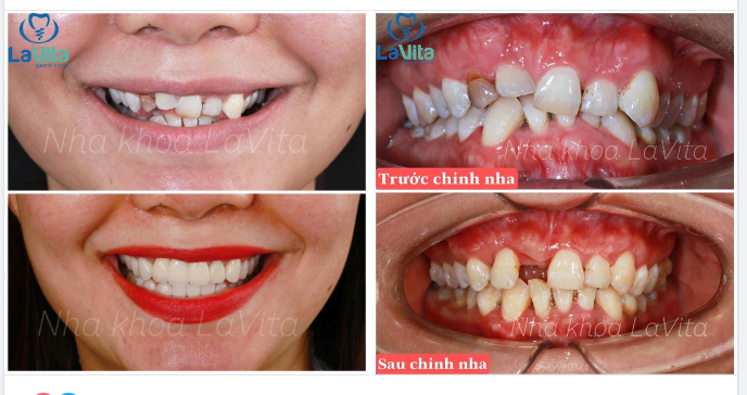 Làm đẹp quan trọng, nhưng sức khoẻ răng miệng lâu dài còn quan trọng hơn nữa