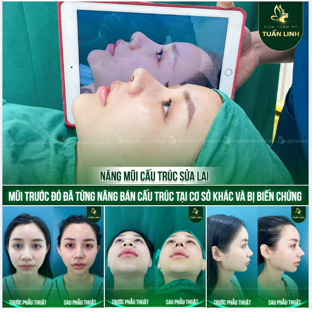 Đã từng nâng mũi tại cơ sở khác cách đây 4 năm bằng phương pháp bán cấu trúc nhưng bị: sống mũi thấp, gãy nhiều, đầu mũi to do mô thịt dày, cánh mũi rộng và không đều nhau,... Dáng mũi không cải thiện được nhiều.