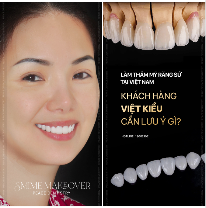 MỘT SỐ LƯU Ý CHO KHÁCH HÀNG VIỆT KIỀU KHI LÀM THẨM MỸ RĂNG SỨ TẠI VIỆT NAM