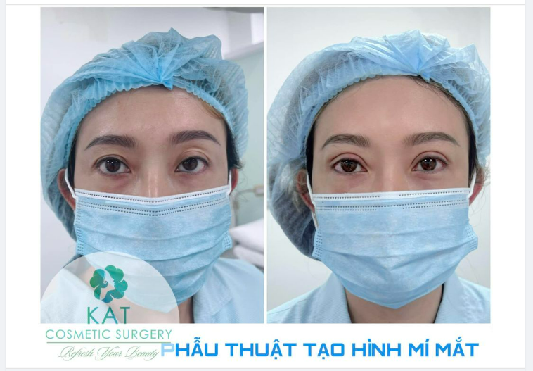Chị khách hàng đến tư vấn vì đôi mắt một bên hốc mắt trũng không có nếp mí và 1 bên mi mắt sụp gây ra tình trạng mắt hai bên hoàn toàn không đồng đều.