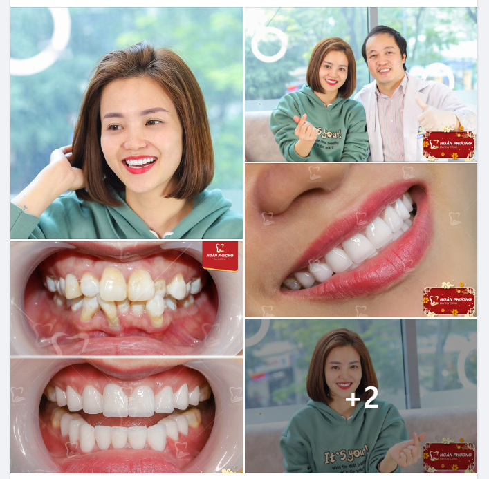 Niềng răng rồi làm sứ  Kiên trì ắt có nụ cười khỏe đẹp