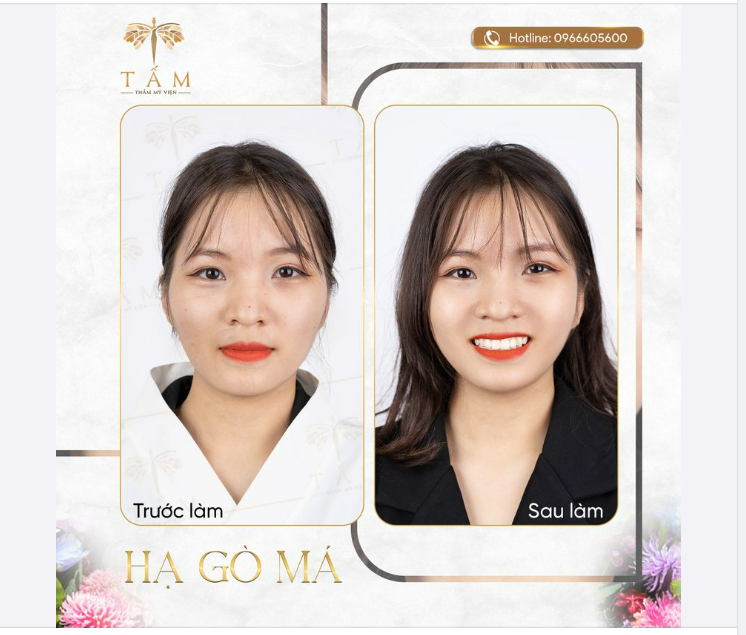 Tiêm hạ gò má được biết đến là phương pháp giúp gương mặt cân đối khắc phục được tình trạng gò má cao.