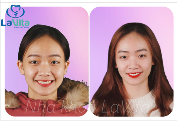 Niềng răng sớm, để “gặt hái” thành quả sớm nha các bạn