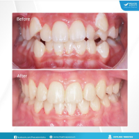 Ca lâm sàng  Răng lệch lạc (răng khểnh), chen chúc - chỉnh nha mắc cài kim loại - hoàn thành sau 22 tháng.