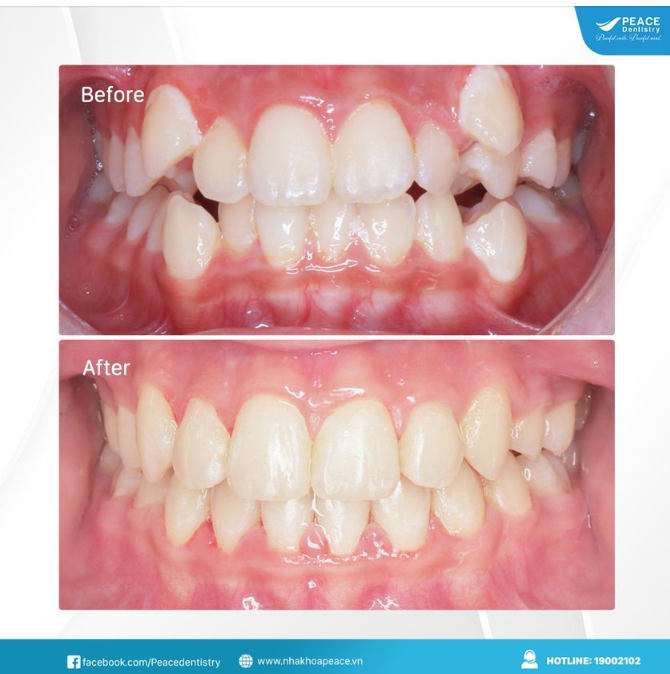 Ca lâm sàng  Răng lệch lạc (răng khểnh), chen chúc - chỉnh nha mắc cài kim loại - hoàn thành sau 22 tháng.