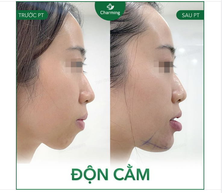 Có khi bạn nghĩ cằm mình ngắn quá nên khuôn mặt trông không đẹp. Nhưng thực tế là cằm bạn không ngắn mà chỉ lẹm hơi sâu mà thôi.