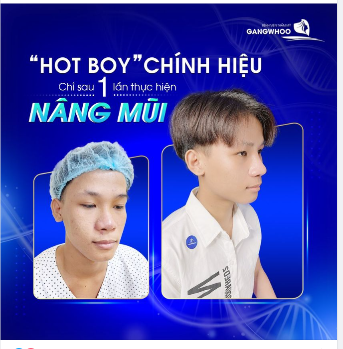 HÓA "HOT BOY" CHỈ SAU 1 LẦN THỰC HIỆN NÂNG MŨI